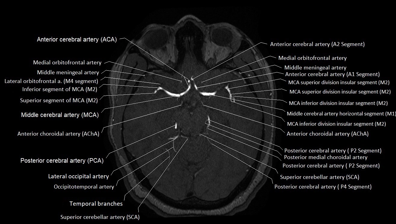 MRA brain (cerebral arteries) anatomy axial 3T image 17.webp